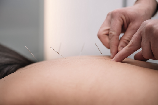 Acupuncture needles during treatment