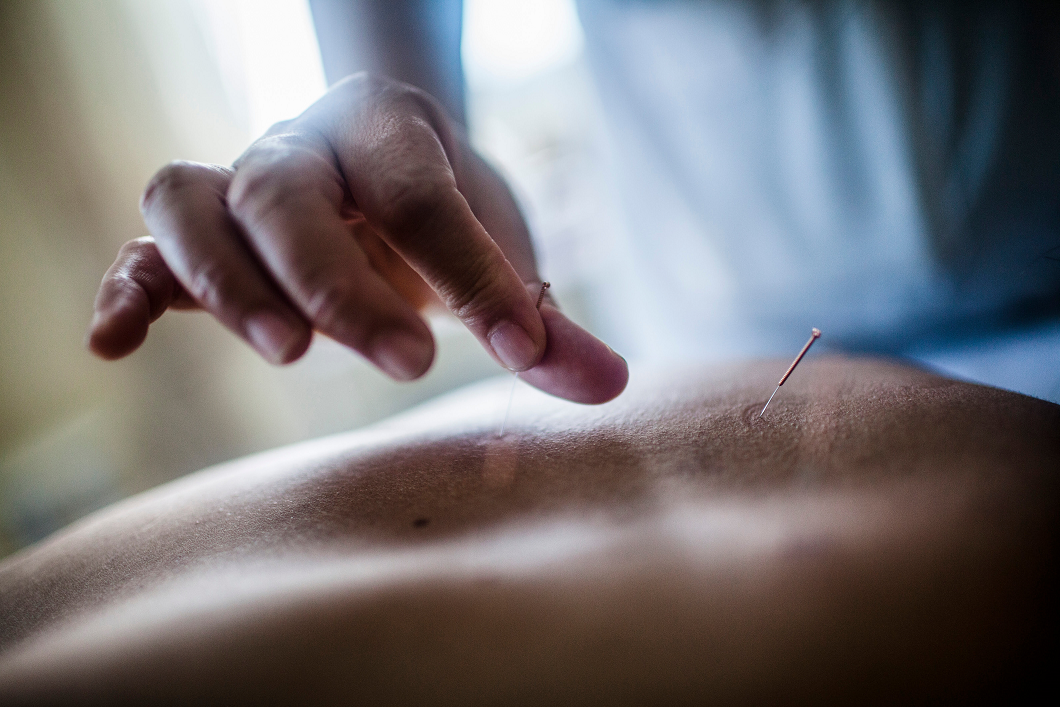 Hand holding a fine acupuncture needle