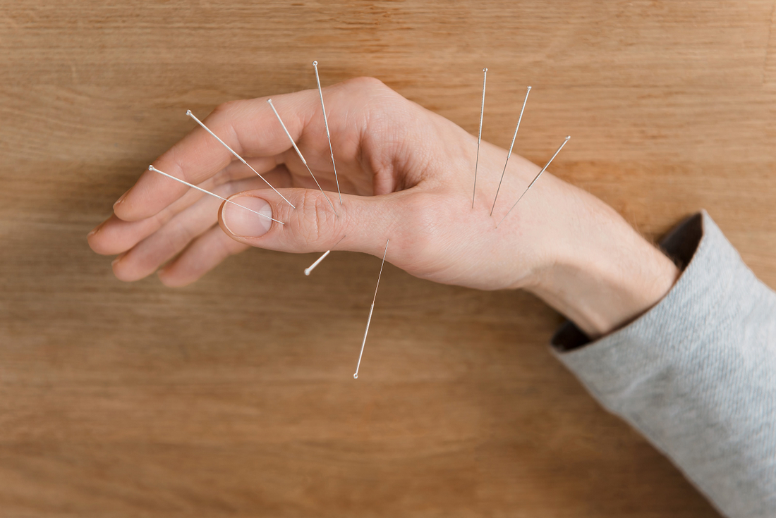 Practitioner using acupuncture needles in treatment